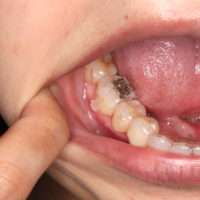 インビザライン治療中に虫歯になったら？虫歯があったら始められない？