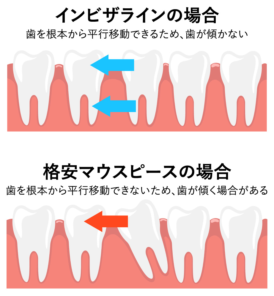 歯の平行移動の比較図