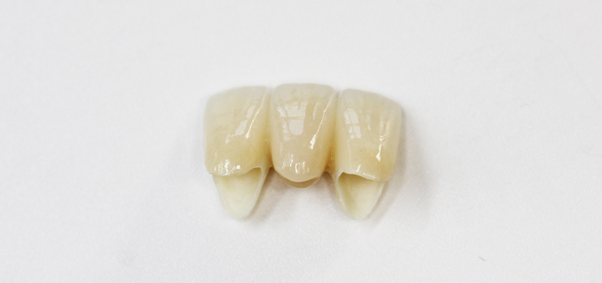 セラミックの人口歯の写真