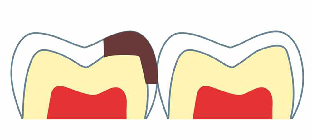 隣の歯との間にできた虫歯