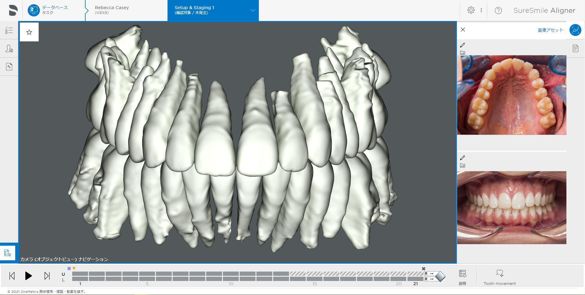 歯根の動きもシミュレーションする安全性