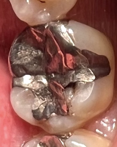 金属の下の虫歯