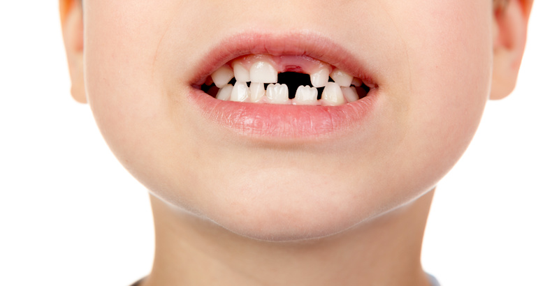 子供の矯正は何歳から？受け口・出っ歯・八重歯の子は早めにチェック!!