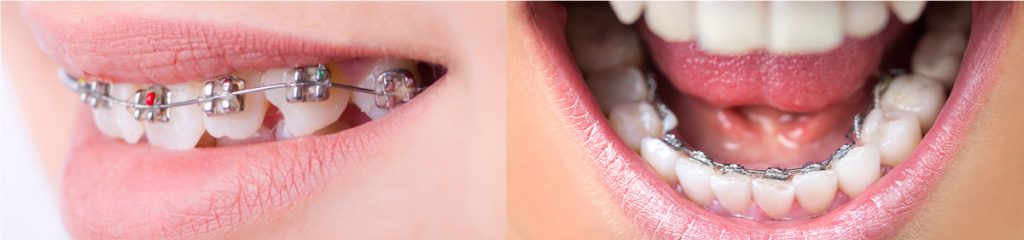 ワイヤー・ブラケット矯正（表側・裏側）の写真