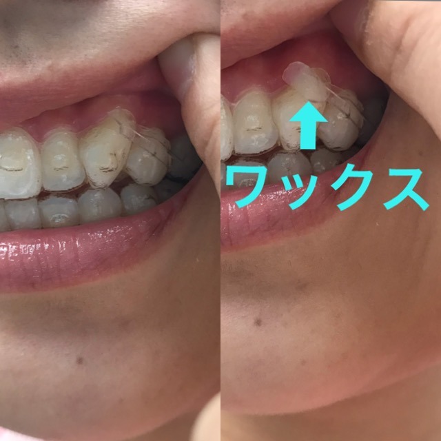 マウスピースに不具合があった時